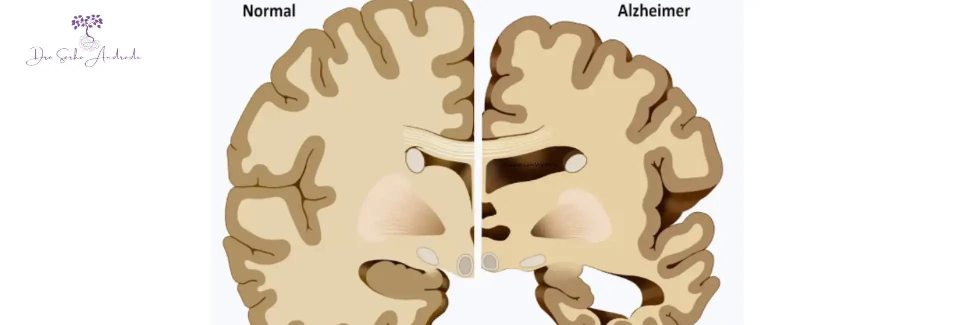 Demência e Doença de Alzheimer